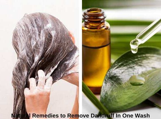 8 Natural Remedies to Remove Dandruff In One Wash