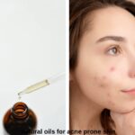 5 Natural Chemical-Free Face Oils for Acne Prone Skin