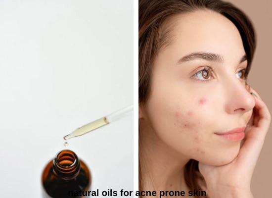 Natural Chemical-Free Face Oils for Acne Prone Skin